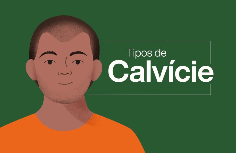 eu sou calvo? 